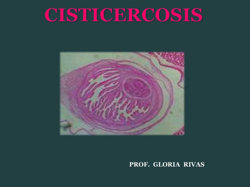 Cisticercosis 