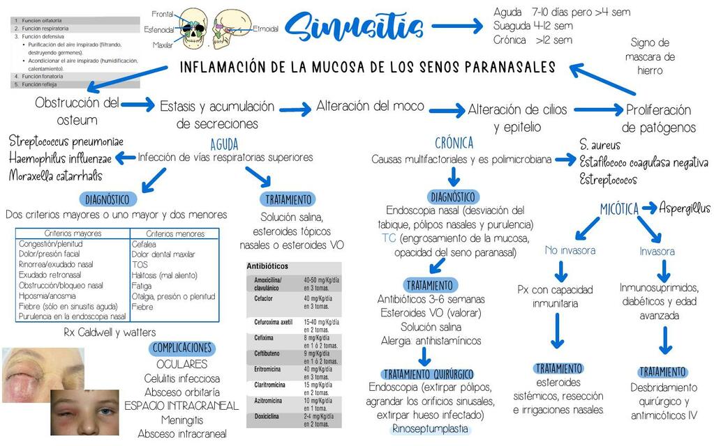 Sinusitis