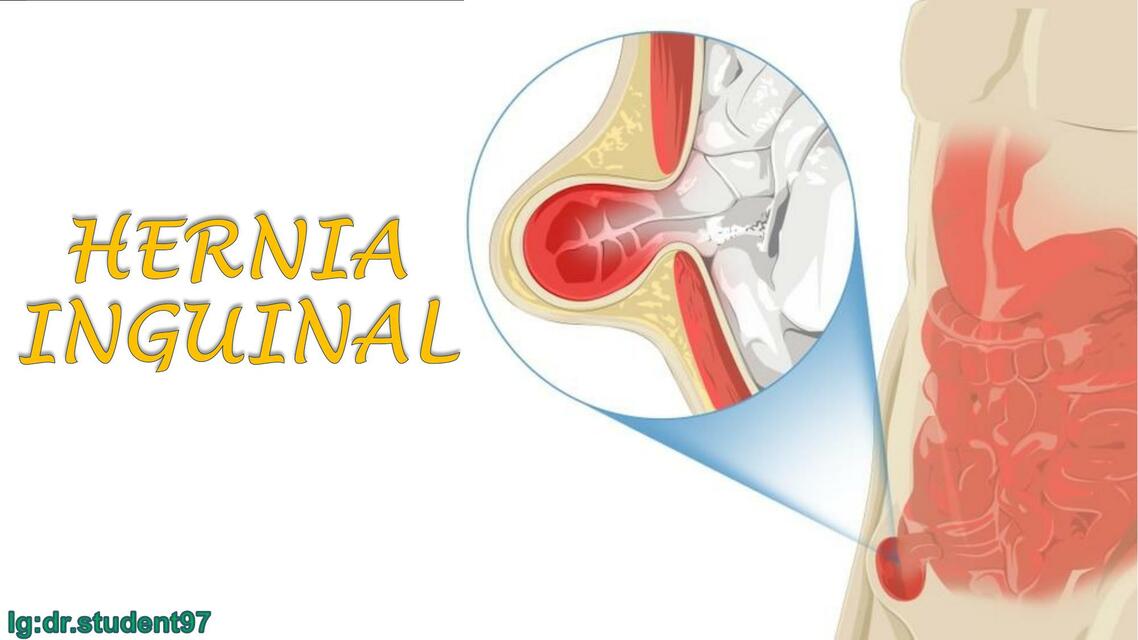 Hernia Inguinal