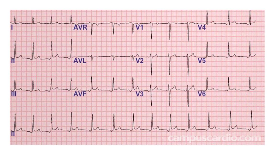 Electrocardiograma 