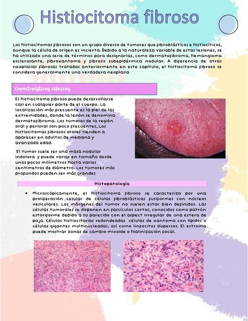 Histiocitoma fibroso