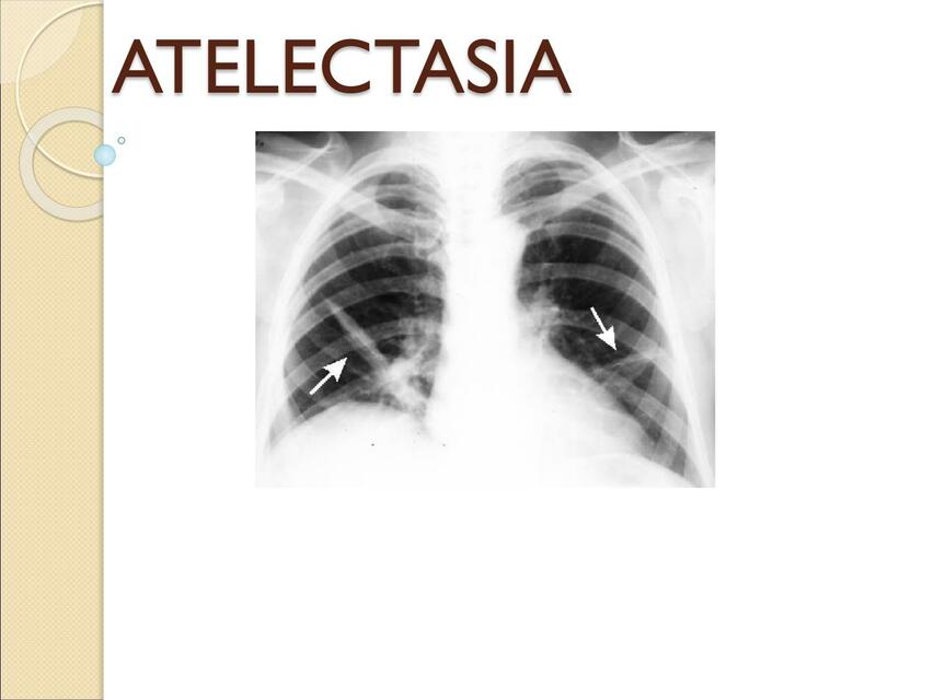 Atelectasia