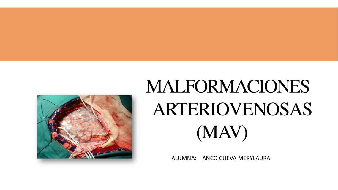 Malformaciones Arteriovenosas