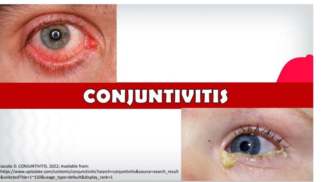 Conjuntivitis 