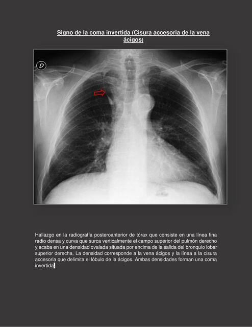Signos Radiológicos de Tórax