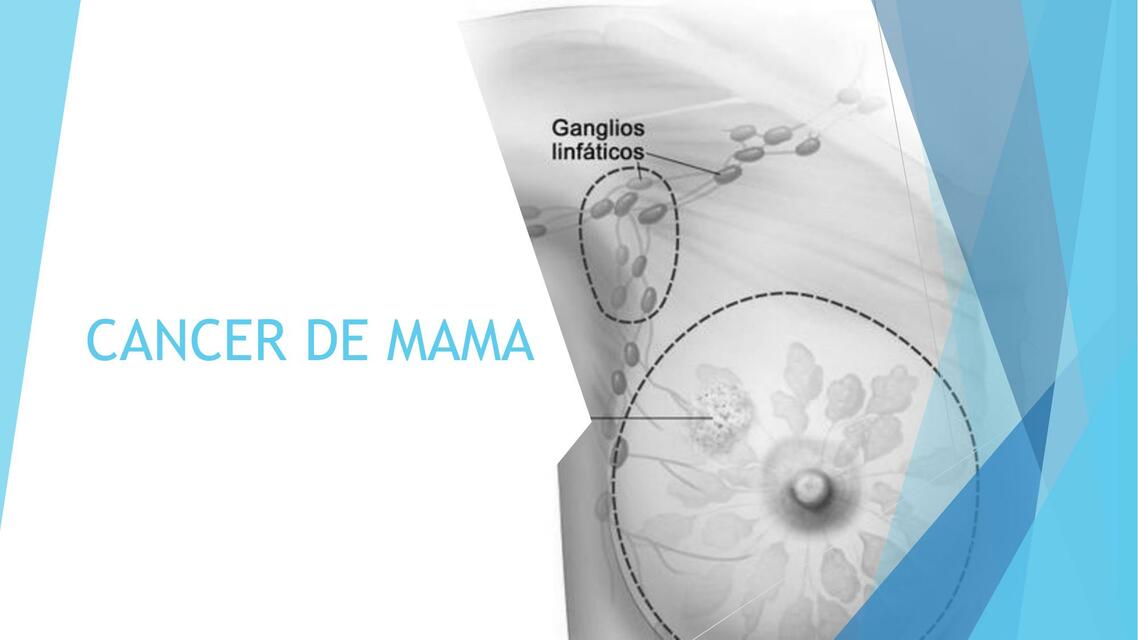 Cáncer de mama