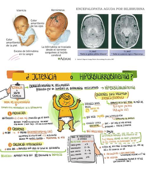 Ictericia 