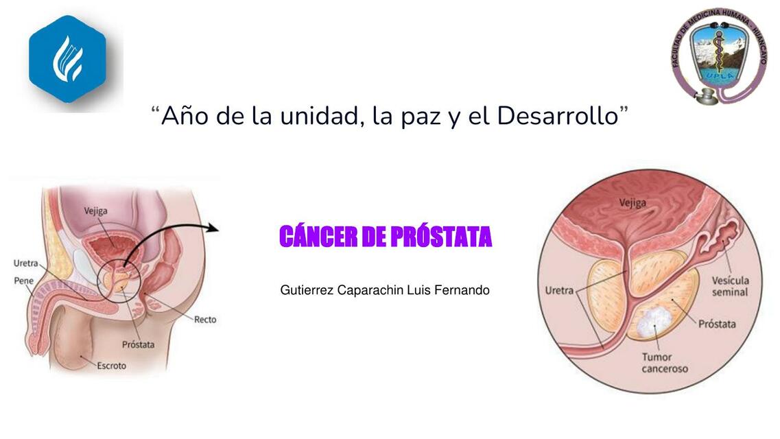 Cáncer de Próstata