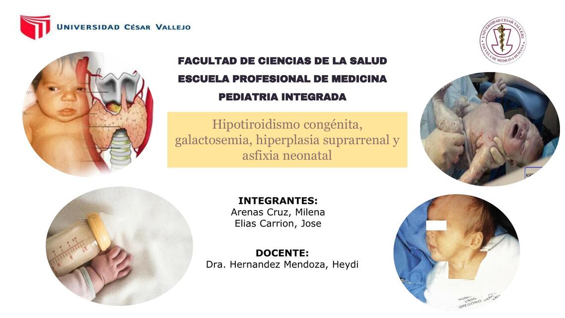 Hipotiroidismo congénito galactosemia hiperplasia