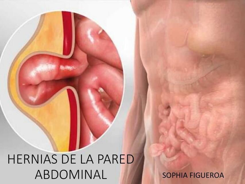 Hernias de la pared abdominal 