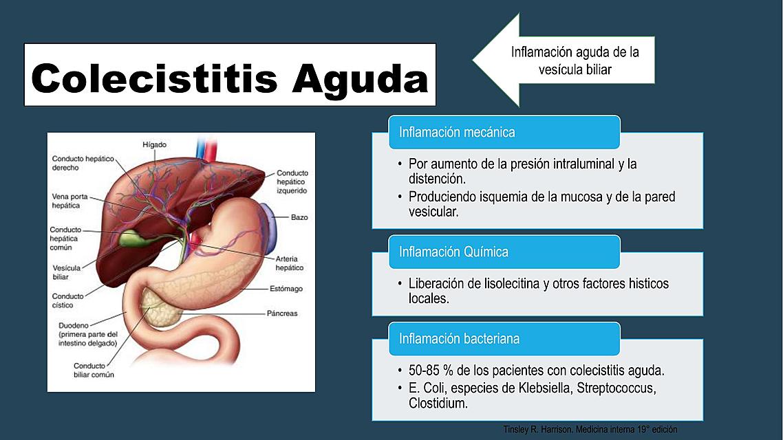 Guia Colelitiasis Colecistitis Aguda Coledocolitiasis Udocz | The Best ...