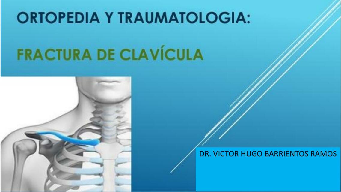 Fractura de Clavícula 