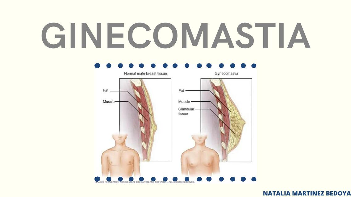 Ginecomastia 