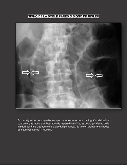 Signos radiológicos de abdomen 