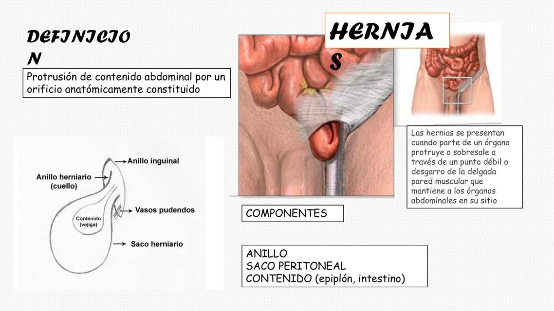 Hernias 