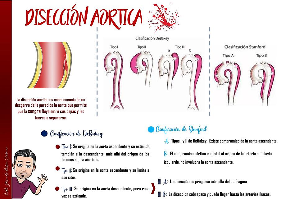 Disección Aórtica