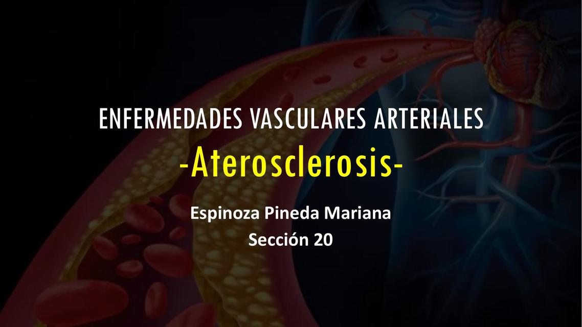 Aterosclerosis  