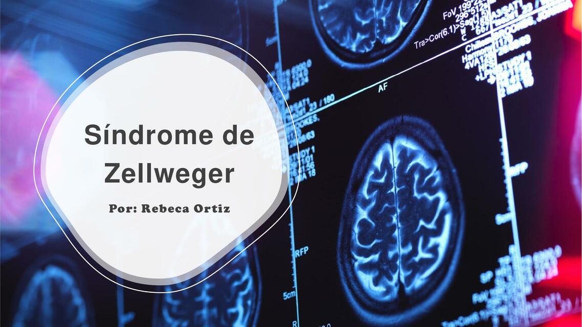 Síndrome de Zellweger Rebeca Ortiz uDocz