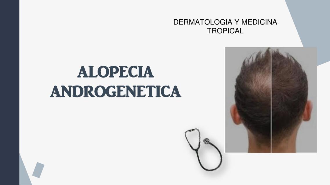 Alopecia Androgénica 