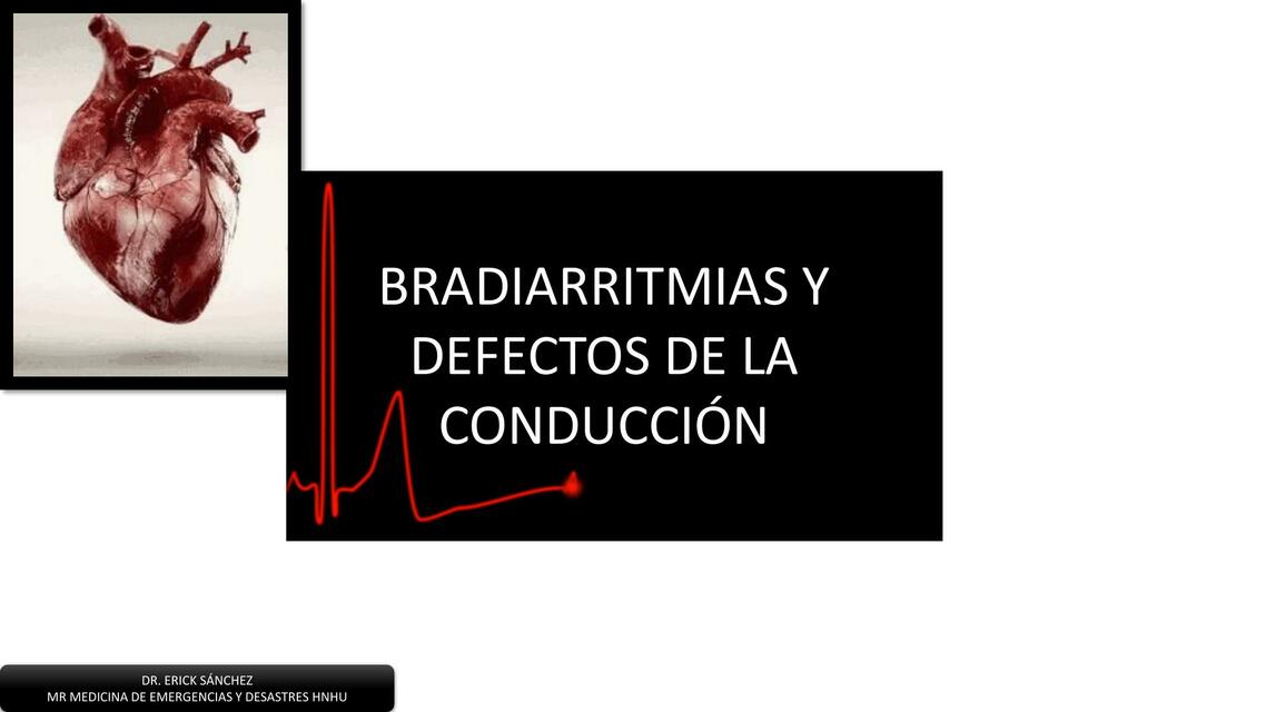 Bradiarritmias y Defectos de la Conducción 