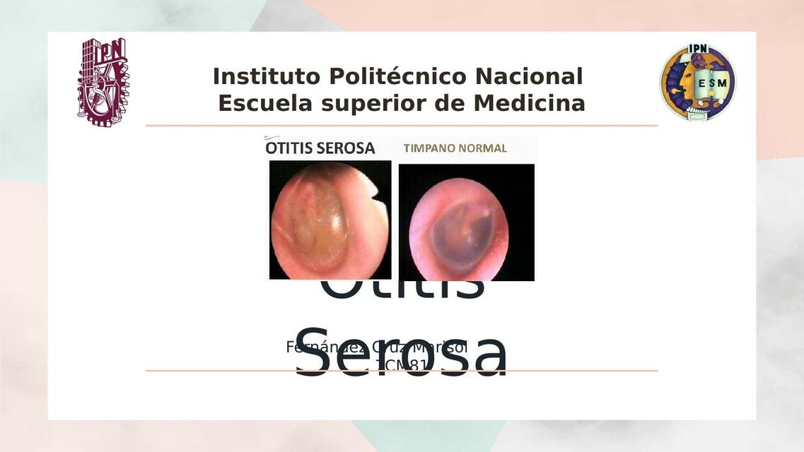 Otitis Serosa 