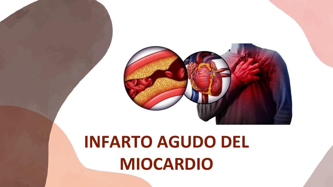 Infarto Agudo del Miocardio 