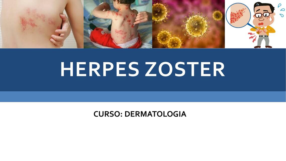 Herpes Zoster 