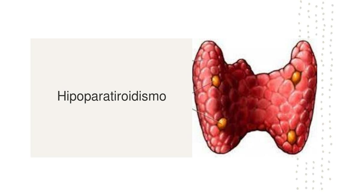 Hipoparatiroidismo