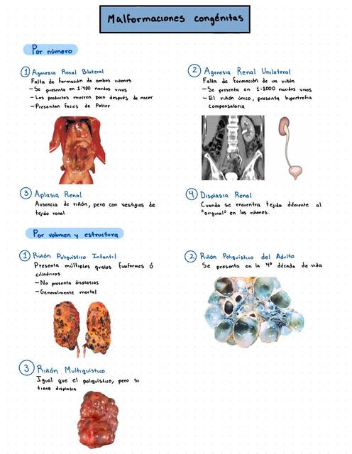 Malformaciones Congénitas Riñones 