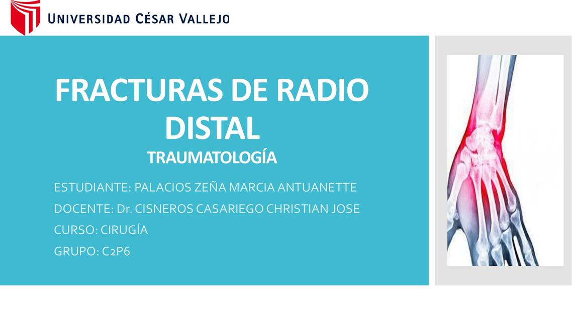 Fracturas de Radio Distal 