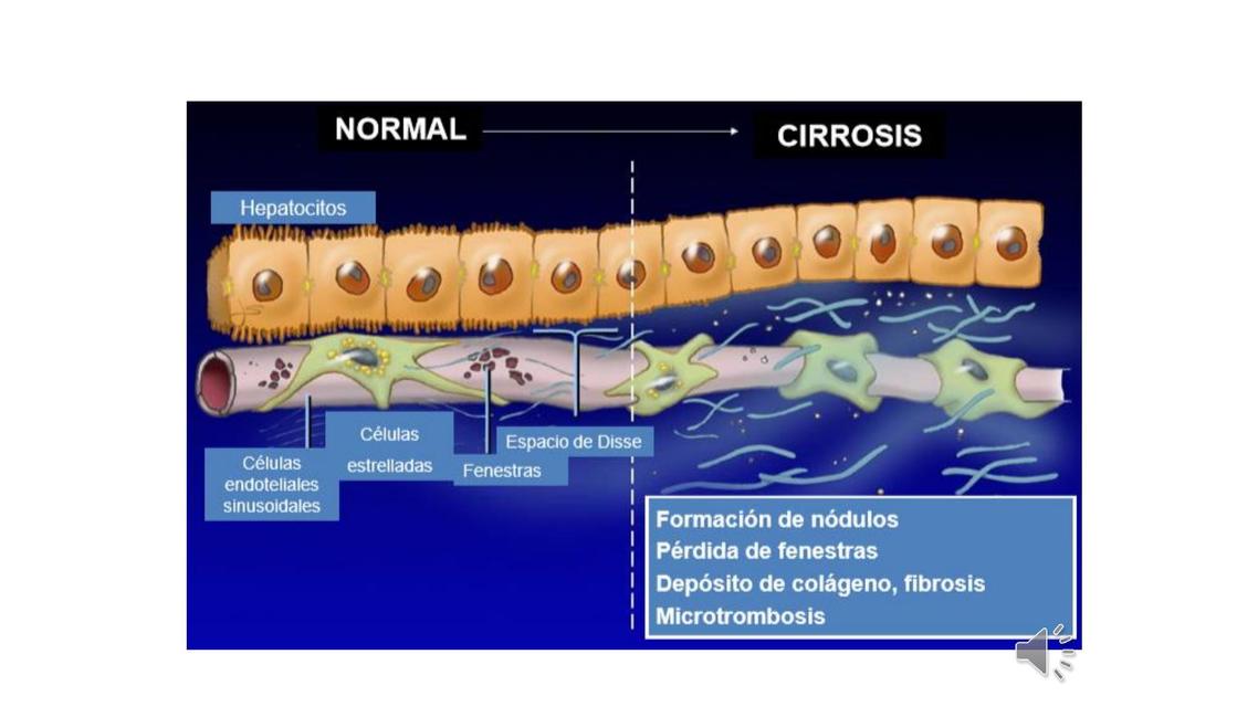 Cirrosis 