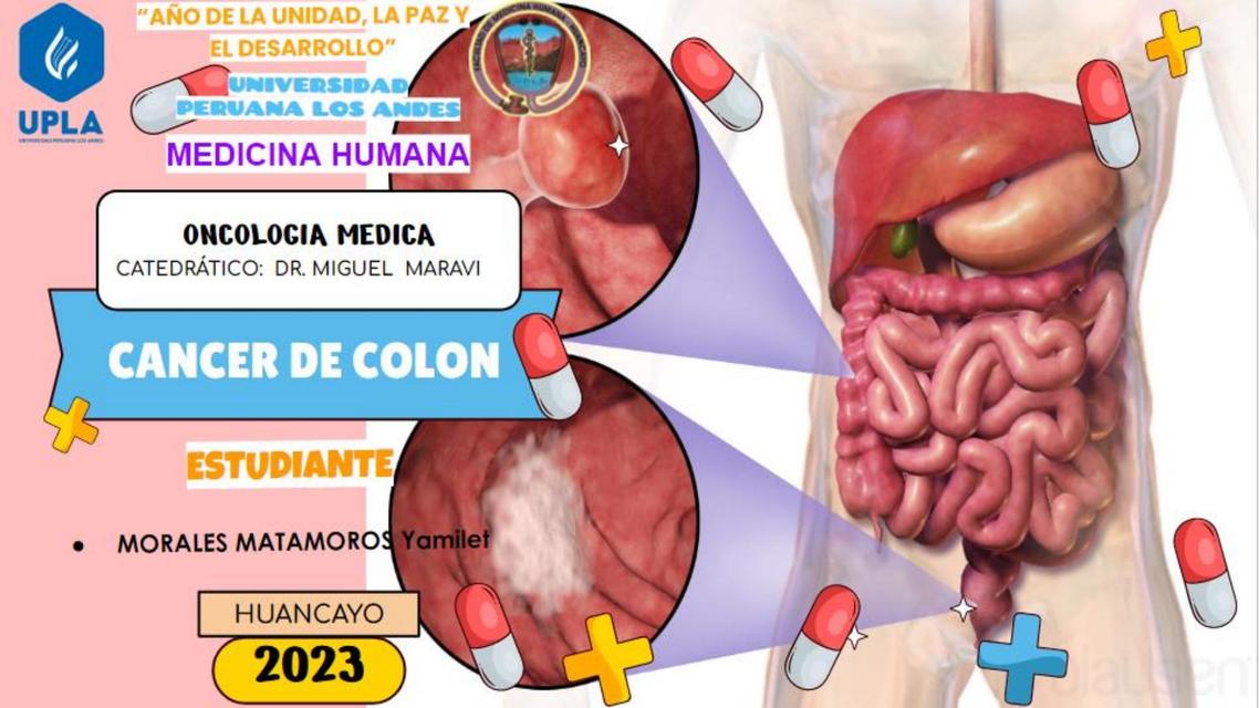 Cáncer de Colon 