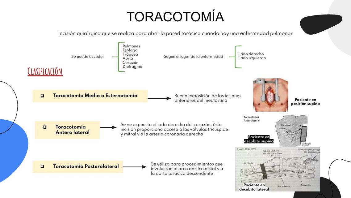 Toracotomía  