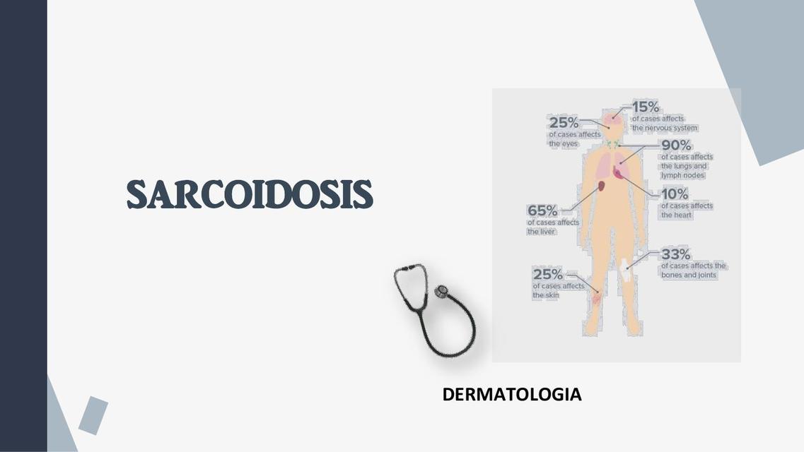 Sarcoidosis 