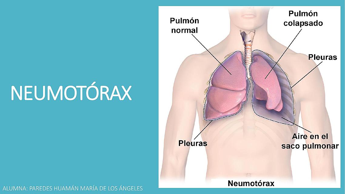 NEUMOTÓRAX ( Bibliografía: Guías de Neumología)