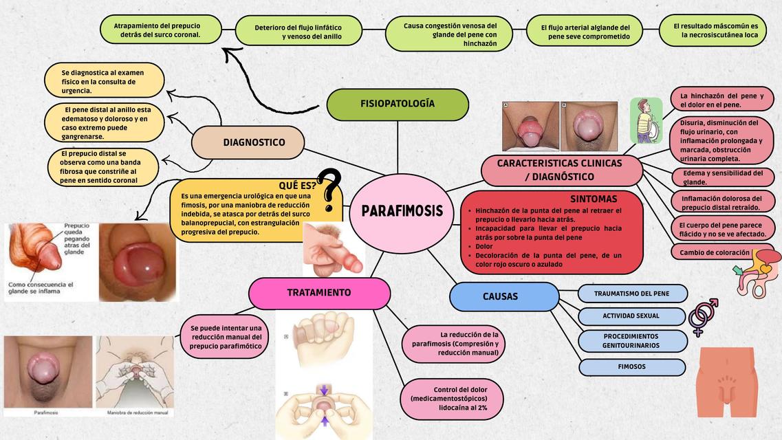 Parafimosis   