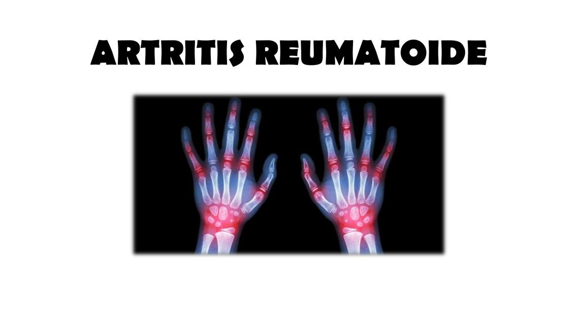 Artritis reumatoide   