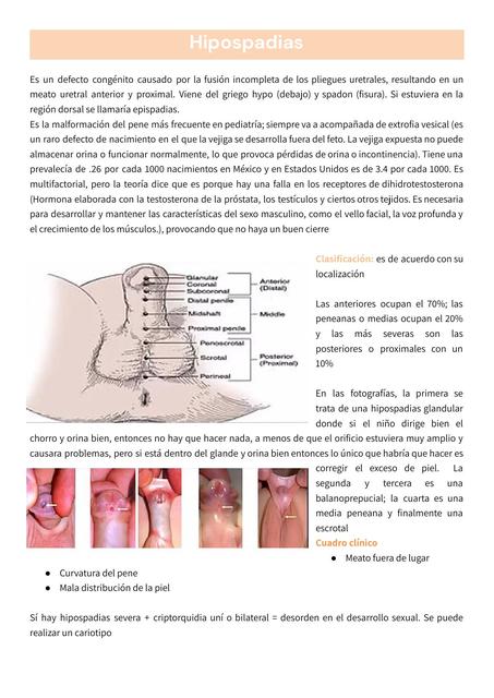 Hipospadias