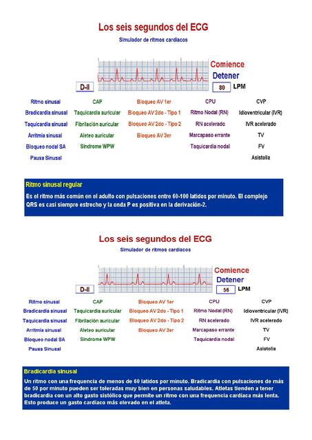 Los Seis Segundos del ECG 