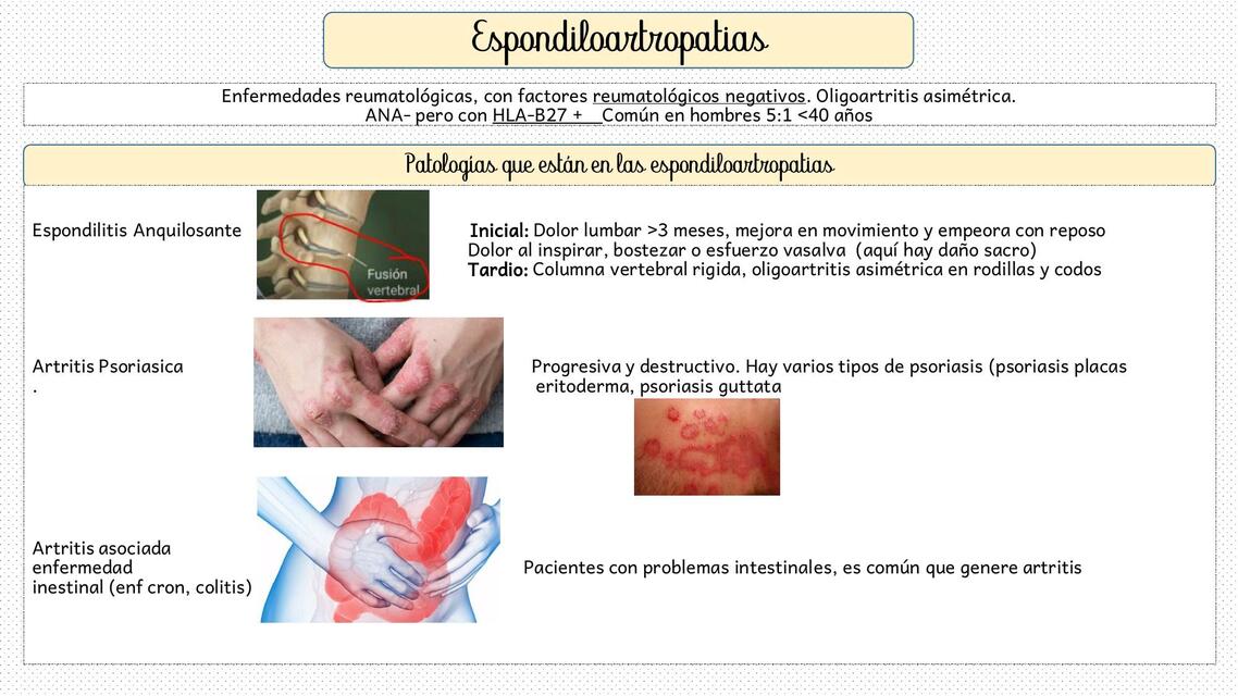 Espondilitis Anquilosante - Reumatología