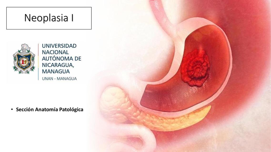  Neoplasia 1