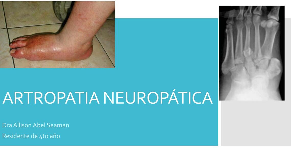 Artropatía Neuropática 