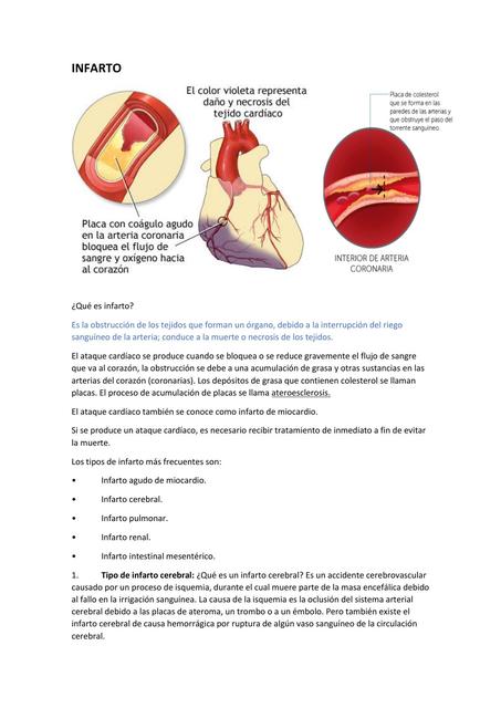 Infarto 