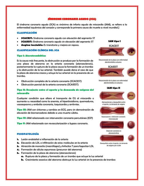 Síndrome coronario agudo 