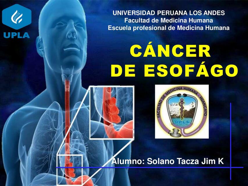 Cáncer de Esófago 