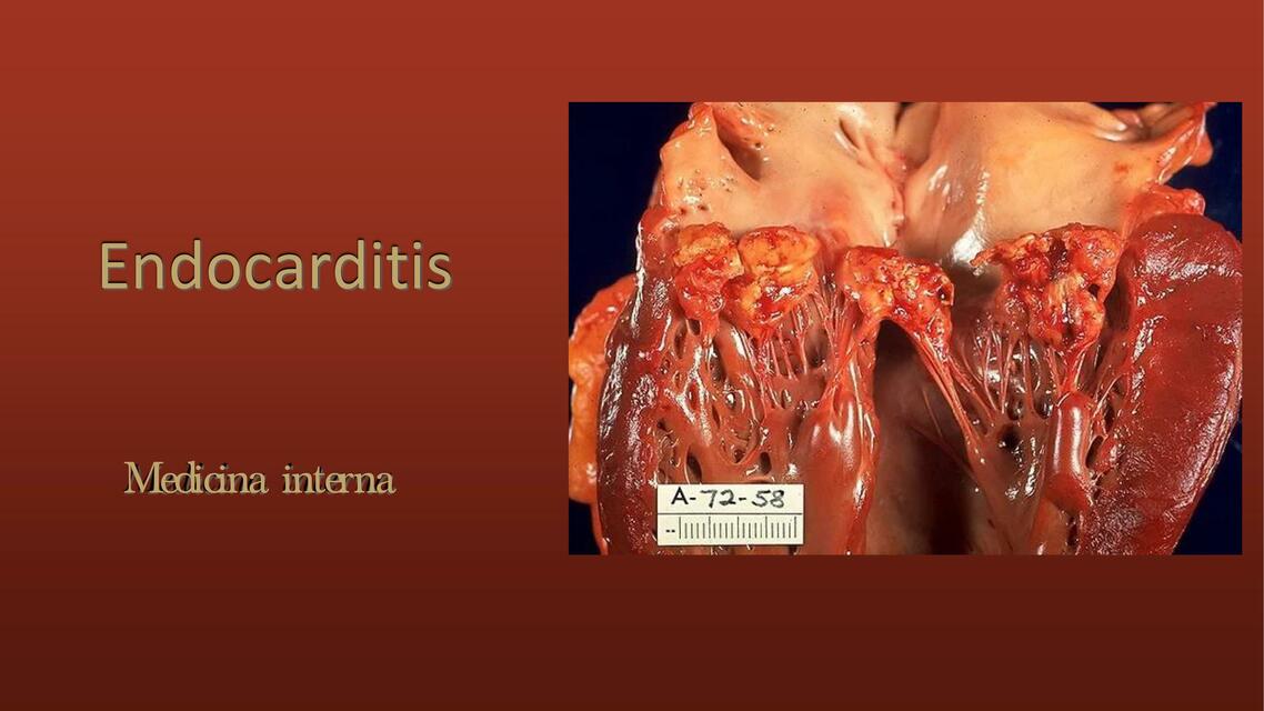 Endocarditis