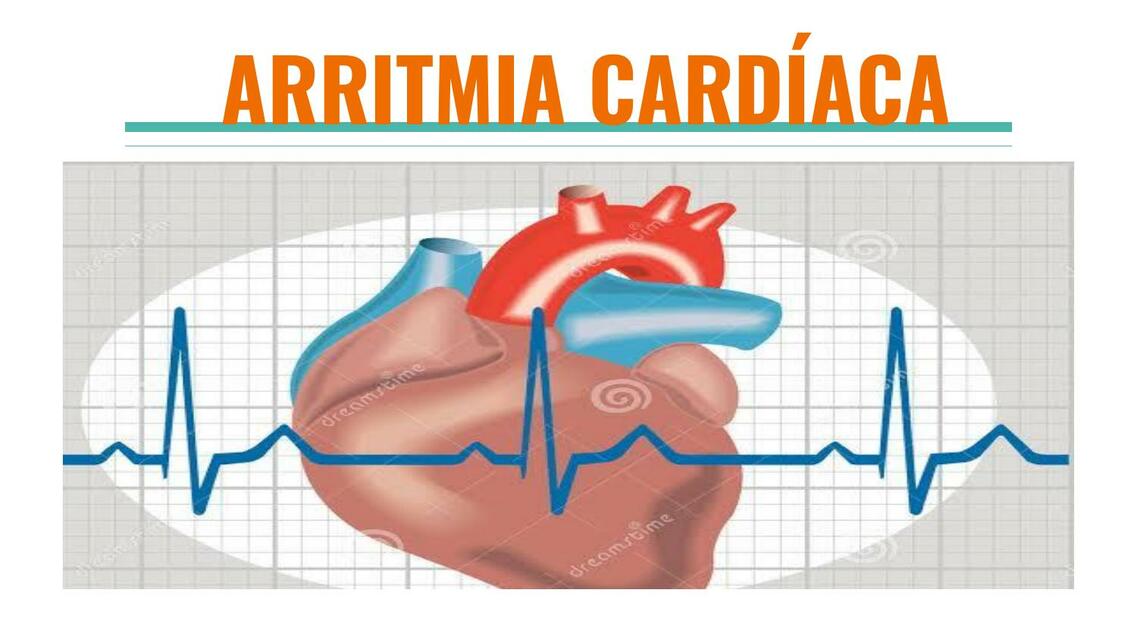 Arritmia Cardiaca 