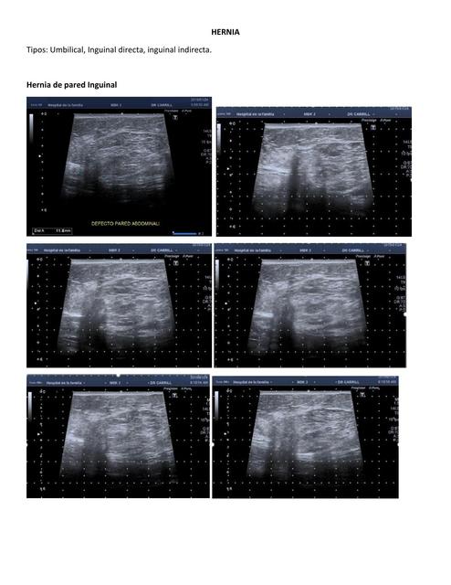 Hernia de pared Inguinal 