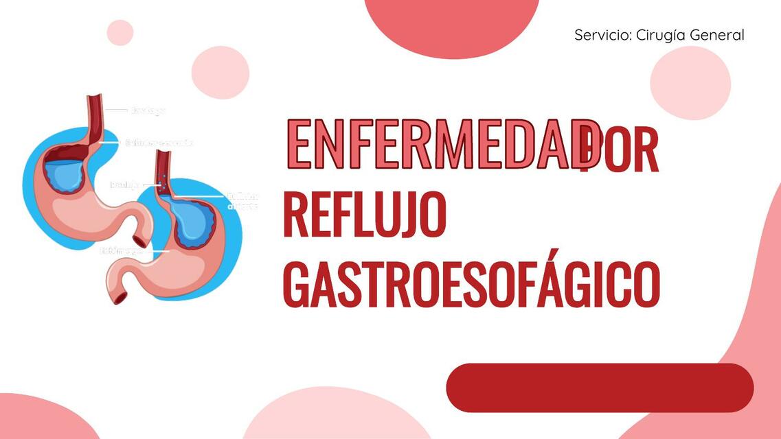 Enfermedad por reflujo gastroesofágico 