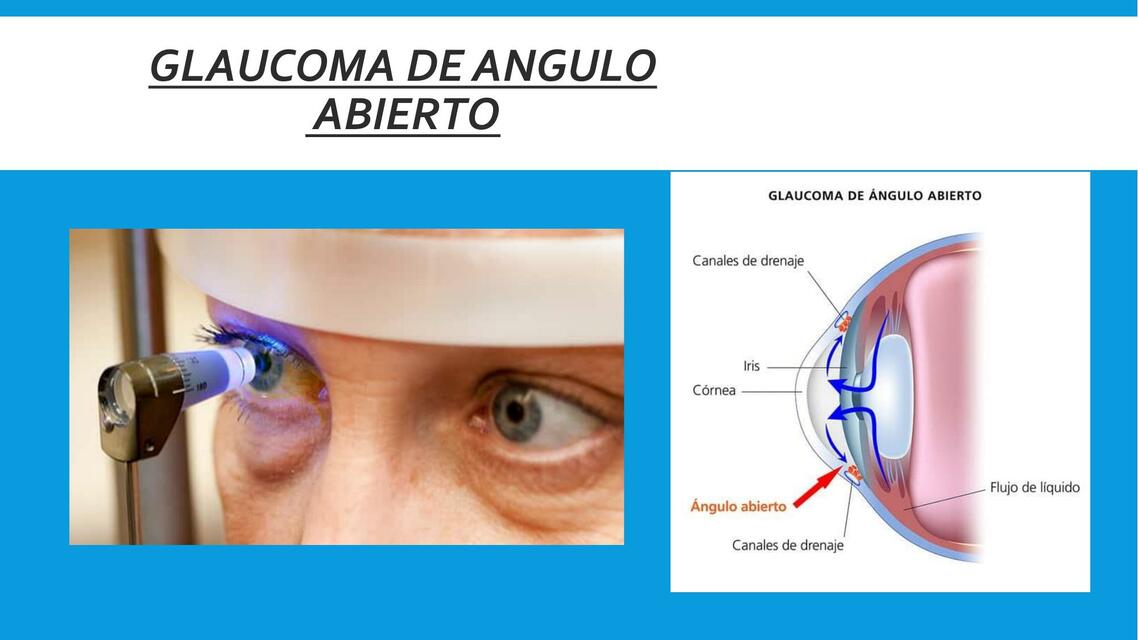 GLAUCOMA DE ANGULO ABIERTO